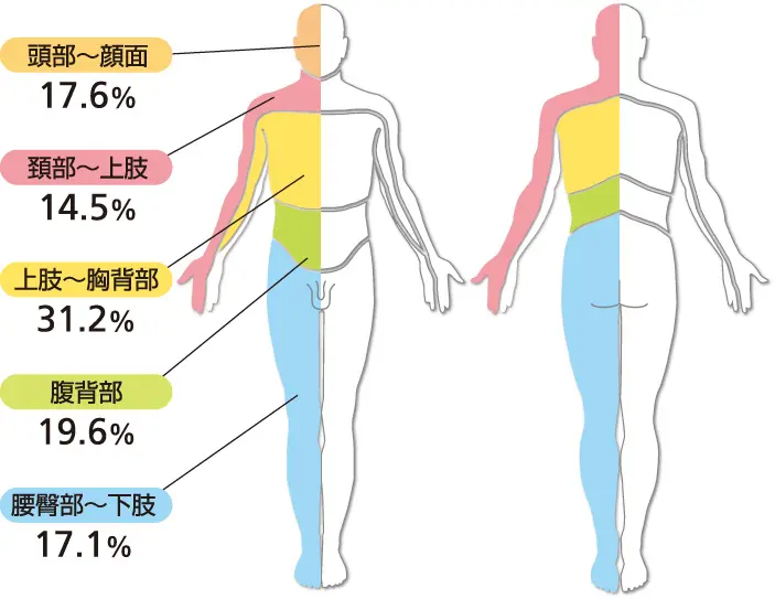 帯状疱疹 ヘルペス 帯状疱疹後神経痛の治療 小西皮ふ科