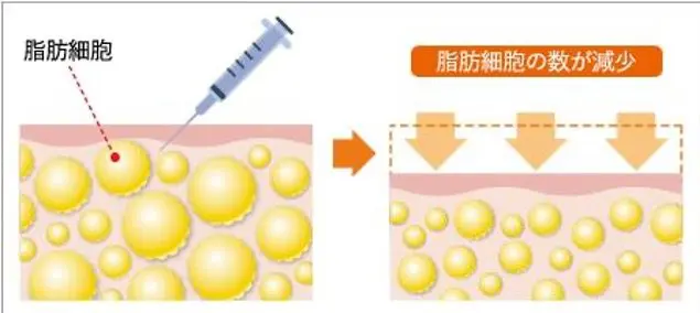 Kabelline(カベリン）脂肪溶解注射✨ | 小西皮ふ科